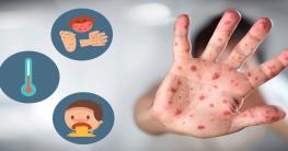 '수족구병 환자 증가' 대구시,  개인위생 관리 생활화 당부 기사 이미지